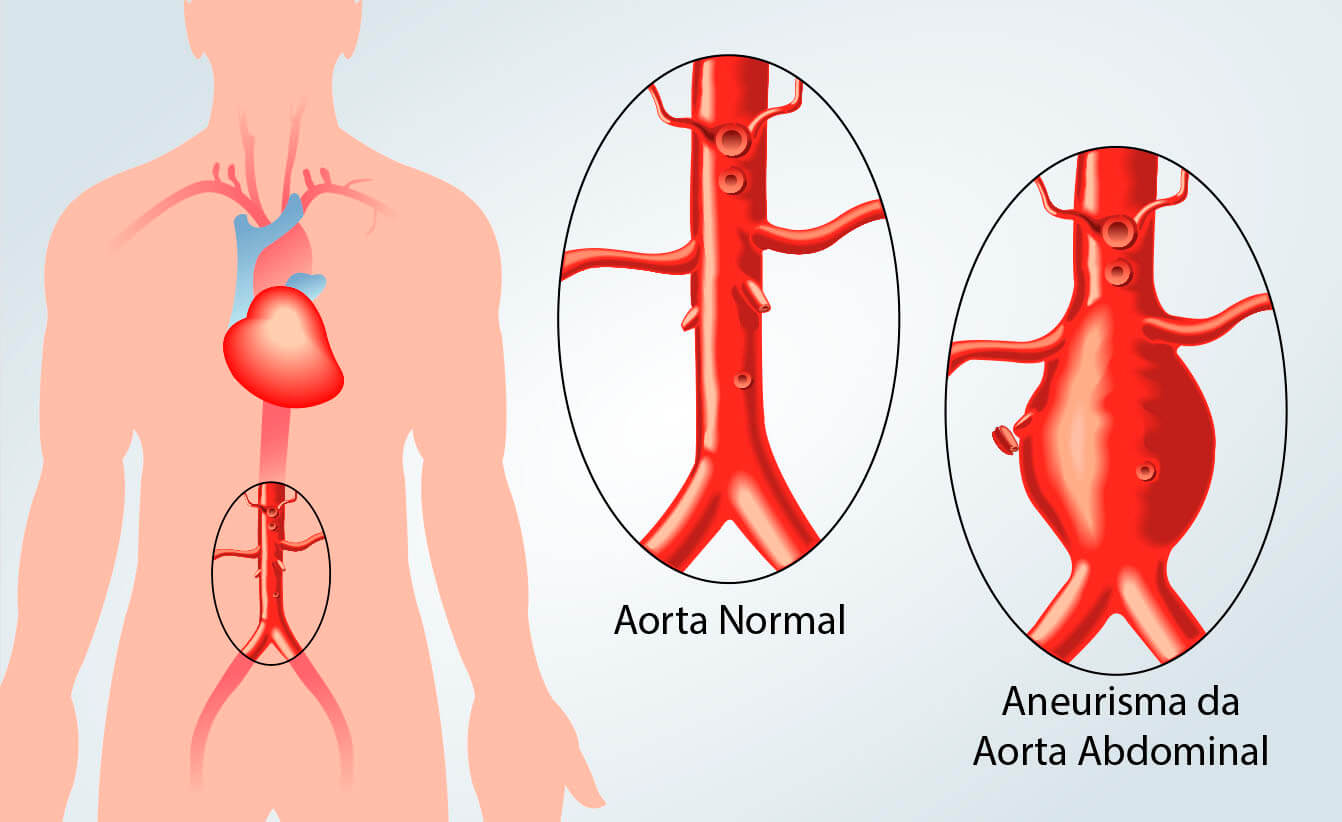 Aneurisma de Aorta Abdominal - Instituto Vida Vascular